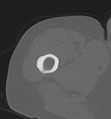 Atypical femur fracture CT 2